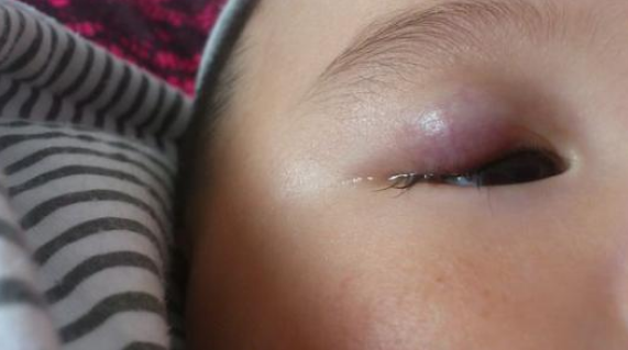 新生儿眼皮肿的图片图片